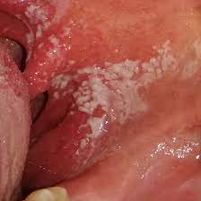 Weisse Flecken Im Hals Foto Gesundheit Und Medizin Gesundheit Pilze