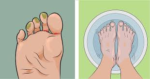 Here S How To Treat Athlete S Foot At Home And Prevent It From Happening Again