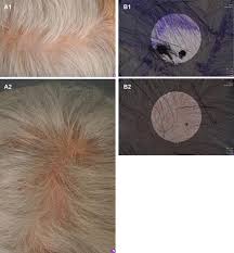 Applying gel isn't difficult, when you have your ideal hair style in mind. Review Of Human Hair Follicle Biology Dynamics Of Niches And Stem Cell Regulation For Possible Therapeutic Hair Stimulation For Plastic Surgeons Springerlink
