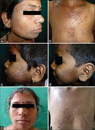Dioxin, a chemical byproduct found in some herbicides, has proved lethal in small doses to laboratory animals. Indian Journal Of Dermatology Venereology And Leprology Three Cases Of Suspected Chloracne In A Family From Pune
