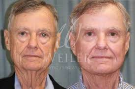 Facelift Before and After Pictures Case 36