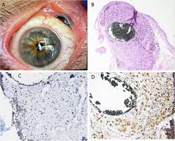 Image result for Conjunctival Foreign Body