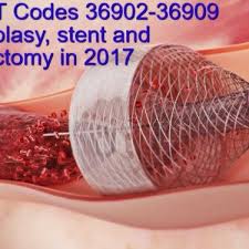 Coding Tips For New Cpt Code 36902 36903 36904 36905 And 36906 Medical Coder Coding Cpt Codes