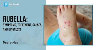 Image result for Rubella
