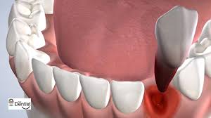 Image result for Tooth Extraction