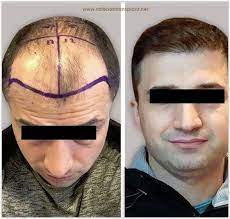 Haar Transplantatie Turkije Voor Na Foto S Hair Loss Remedies Hair Loss Symptoms Hair Transplant