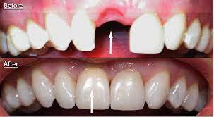 Big cost, but i asked for a discount if i paid it all up front, so i got $200 off, plus the dentist is bleaching my teeth for only $100 since he already has to do so some insurance plans do cover part of an implant. Front Tooth Implant Dental News Network