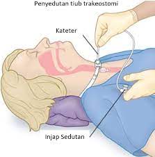 Tetapi di samping itu, ketidakselesaan di tekak juga boleh menjadi gejala keadaan kesihatan tertentu. Angin Tersekat Di Tekak Almisalie