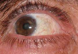 Best Pterygium Surgeon Thousand Oaks Oxnard Los Angeles