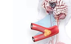 Promptly spotting stroke symptoms leads to faster treatment and less damage to the brain. Types Of Stroke American Stroke Association
