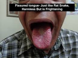 Image result for Fissured tongue