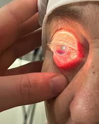 Image result for Hyphema