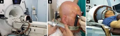 Image result for Thalamotomy