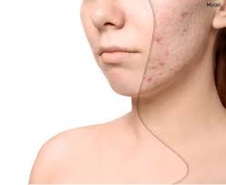 Unfortunately, though, scarring is a fact of life for many people with acne, particularly if treatment started late or wasn't entirely successful. How Microneedling Can Improve Acne Scars Other Uses