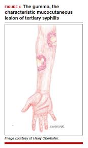 Image result for Tertiary Syphilis