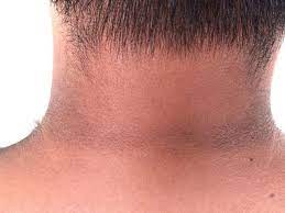 Maybe you would like to learn more about one of these? Awas 12 Perubahan Kulit Ini Tanda Gejala Diabetes