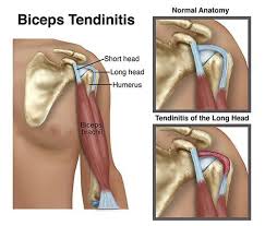 Image result for Biceps Tendon Injection