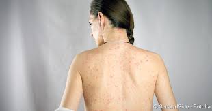 Eine infektion mit dem coronavirus kann forschern zufolge zudem auf der haut spuren hinterlassen. Roteln Symptome Ansteckung Behandlung Schutz Netdoktor