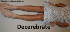 Image result for Decorticate Posturing