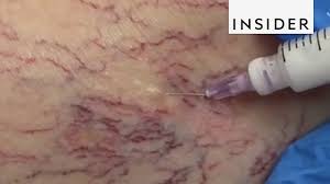 Not only this, bilberry is very useful in getting rid of spider veins as it improves blood circulation. How Doctors Get Rid Of Spider Veins Youtube
