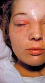 Eyelid and Orbital Infections