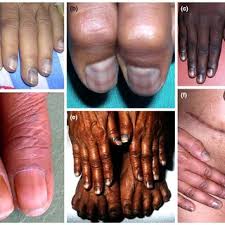 Image result for Muehrcke Line