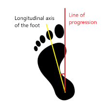 Image result for Foot Progression Angle