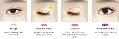 Triple eyelids after double eyelid surgery Incisional Double Eyelid Surgery Answer Plastic Surgery