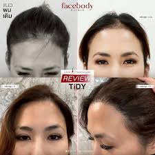 FACEBODY HAIR (หมอธีร์) แพทย์ผู้เชี่ยวชาญด้านการปลูกถ่ายเส้นผม
