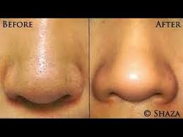 Cara Menghilangkan Komedo Dengan Pasta Gigi Dan Garam Youtube