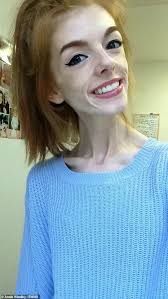 Former anorexic claims that her unexpected chocolate craving was the key to  the recovery