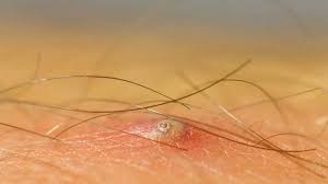 You are more likely to get ingrown hairs in areas you shave, such as: Ingrown Hair On Penile Shaft Removal Identification And Causes