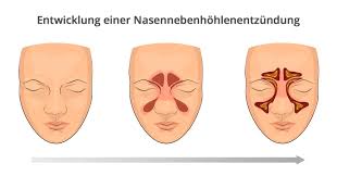Eine sinusitis entwickelt sich meist aus einer vorausgegangenen erkältung und ist, wenn auch sehr unangenehm, oftmals harmlos. Nasennebenhohlenentzundung Behandlung Volksversand Versandapotheke