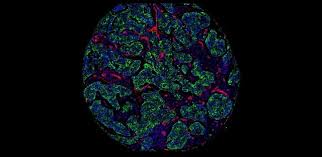 The two most common causes of breast lumps are fibrocystic breast condition and cysts. Breast Cancer Map Reveals How Mutations Shape The Tumour Landscape Healthcare In Europe Com
