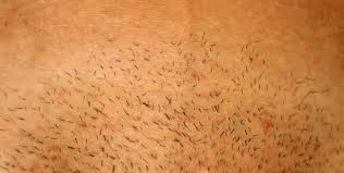 Et ce n'est pas fini ! 5 Astuces Naturelles Pour Eviter Tout Bouton Apres Epilation Et Les Irritations