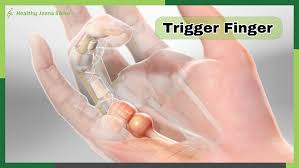 Image result for Trigger Finger