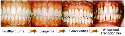 How To Reverse Periodontal Disease Without Surgery Peter Galgut