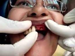 Bila dah sakit gigi semua benda jadi serba tak kena. Dental Implant Tanam Gigi Implant Gigi Youtube