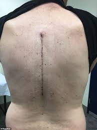 This kind of flap has a texture identical to what was there before the lesion. Freedomroo Man Reveals 17 Year Battle With Skin Cancer And Urges Everyone To Check Their Skin Australiannewsreview