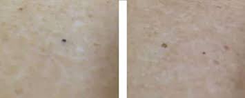 Blackheads are caused when a combination of naturally occurring oil (or sebum) and dead skin cells clog your hair follicle. Why Do I Develop Blackheads On My Inner Thighs Or Why Are My Inner Thighs Darkened With Small Dark Headed Bu Blackheads Inner Thigh Bumps Get Rid Of Blackheads