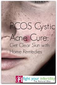 One of the natural supplement to cure pcos is furocyst is a proprietary and clinically evaluated product for the management of pcos (polycystic ovarian syndrome). Pcos Cystic Acne Cure Get Clear Skin With Home Remedies