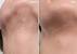 Home Laser Hair Removal Before And After