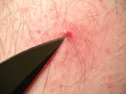 It's not a huge wound but it looks pretty deep. Ingrown Hair Removal Health Care Tips