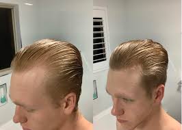 Stress causes permanent hair loss in women. Three Months Minoxidil Finasteride Treatment 19 Year Old Male Hairloss