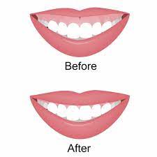 If the slightest imperfections in your smile are making you feel insecure. How To Fix A Gummy Smile Ultimate Guide To Gummy Smile Reduction