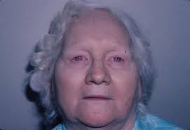 Hypopigmentary Skin Disorders