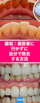歯垢 歯医者に行かずに自分で除去する方法 自宅で手軽に歯石ケア 歯垢をとる 自宅で簡単に 歯医者いらず 重曹 ティーツリーオイル 歯石を取る 歯石 歯石除去 歯 ホワイトニング