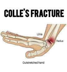 Image result for Fall on Outstretched Hand