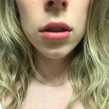 No one can answer how to plump lips permanently? Exactly What To Expect From Lip Fillers Into The Gloss