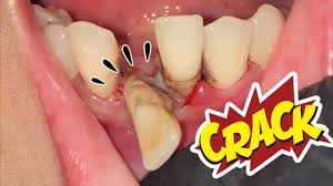 Di dalamnya terdapat kandungan diclofenac potassium yang akan membantu mengurangi rasa sakit pada gigi. Cabut Gigi Goyang Akibat Karang Gigi Dokter Gigi Tri Putra Youtube